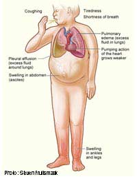 Heart Failure Blood Pump Heart Attack