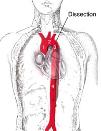 Aortic Dissection Aorta Artery Left