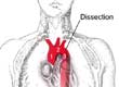What is an Aortic Dissection?