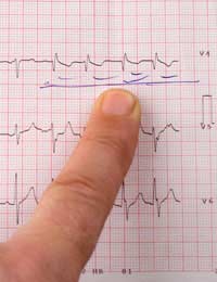 Aortic Stenosis Aorta Contraction