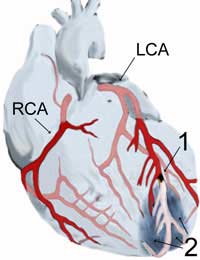 Myocardial Infarction Heart Attack