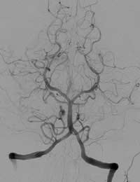 Cardiac Angiogram Coronary Arteries