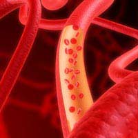 Fibrinogen Blood Clotting Heart Surgery